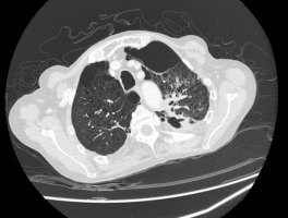 【越南确诊第155例患者,越南确诊一例新型冠状病毒】