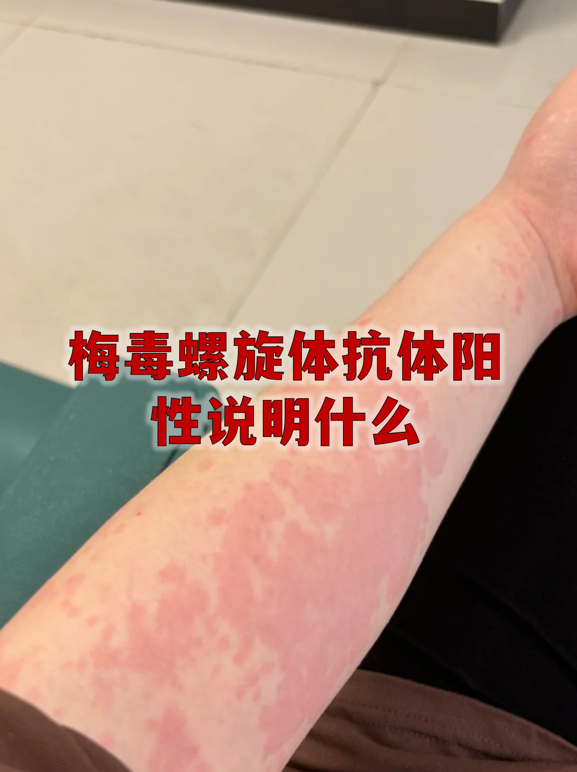 【全国梅毒疫情地区分布,中国梅毒分布】